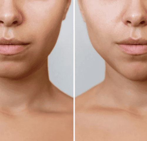 Bichectomy Surgery in Turkey Bichectomy Surgery in Turkey
