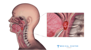 Radiotheraphy For Throat Cancer 