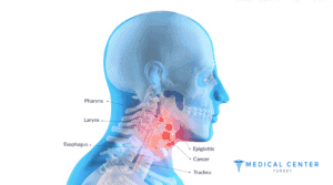 Radiotheraphy For Throat Cancer 