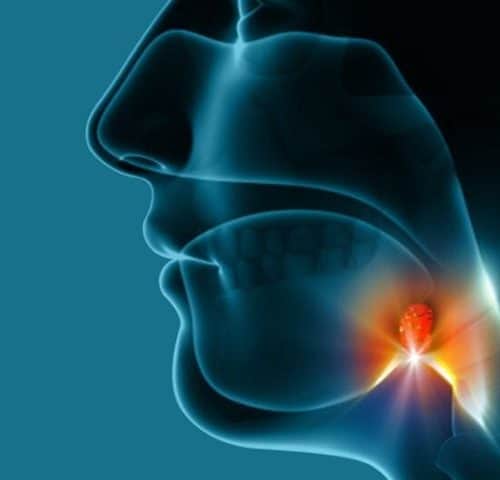 Radiotherapy for Throat Cancer Radiotherapy for Throat Cancer