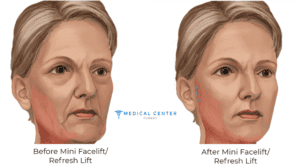 FacelIft at Home How to do FacelIft without Surgery (1)