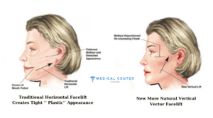 FacelIft at Home How to do FacelIft without Surgery (2)