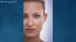Facelift Healing Time