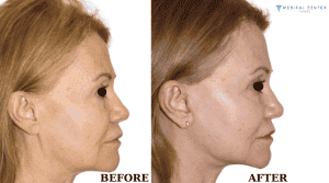 The Complete Guide to Facelift Surgery 