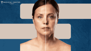 Facelift Healing Time