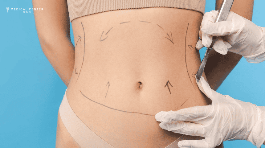 Liposuction Healing Time Liposuction Healing Time