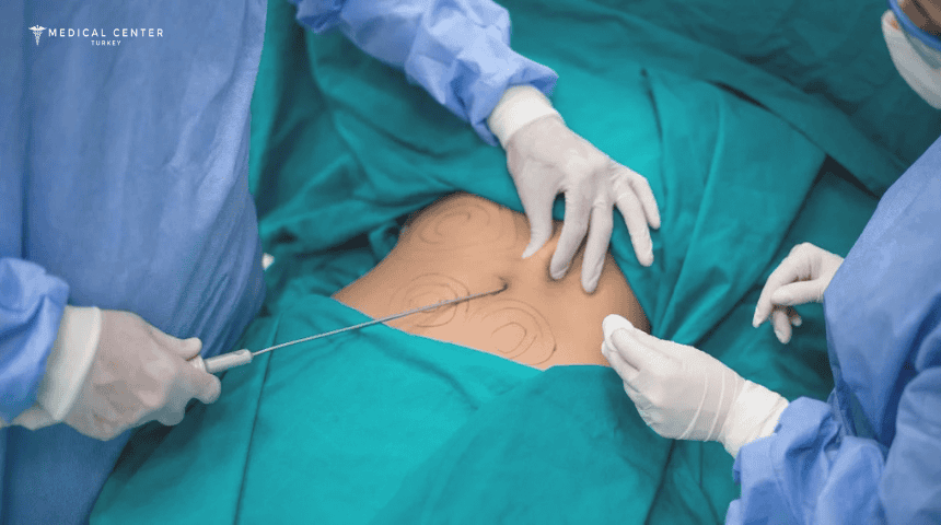 Is Liposuction Painful? Is Liposuction Painful?