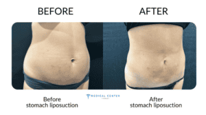 Liposuction Healing Time