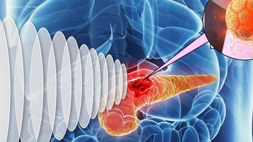 Early Cancer Detection in Turkey? Early Cancer Detection in Turkey?