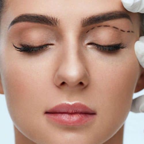 Eyelid Surgery (Blepharoplasty) Techniques in Turkey Eyelid Surgery (Blepharoplasty) Techniques in Turkey