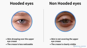 Hooded Eyes Makeup Botox Surgery in Turkey