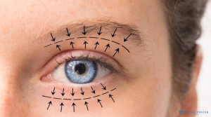Hooded Eyes Makeup Botox Surgery in Turkey