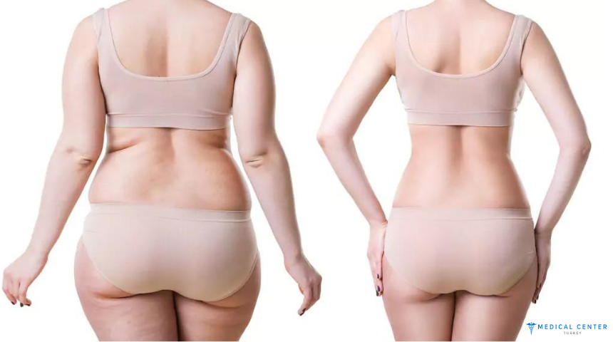 Liposuction in 2025