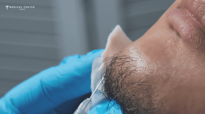 Beard Transplant in Turkey: Lower Cost, Top Care Beard Transplant in Turkey: Lower Cost, Top Care