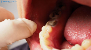 Black Teeth: Causes & Treatments in Turkey