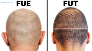 Understanding the Different Types of Hair Transplants and Which One Is Best