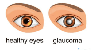 Types of Eye Operations in Turkey 