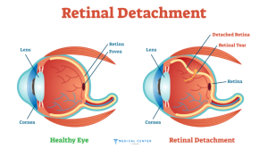 Types of Eye Operations in Turkey 
