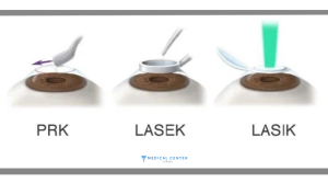 Types of Eye Operations 