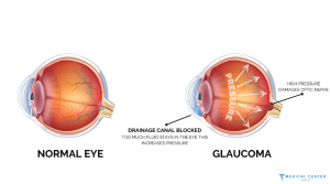 Types of Eye Operations