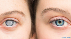 Types of Eye Operations 