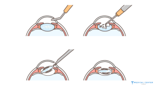 Types of Eye Operations in Turke