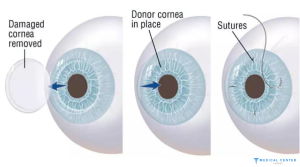 Types of Eye Operations in Turkey 