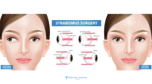 Types of Eye Operations 