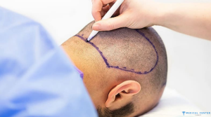 Is Turkey the Best Destination for Hair Transplants?