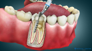 Dental Treatment Guide in Turkey