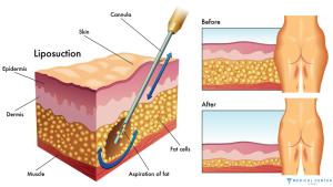 Liposuction in Turkey: Types, Prices, Procedures
