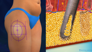 Liposuction in Turkey: Types, Prices, Procedures