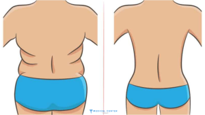 Liposuction in Turkey: Types, Prices, Procedures