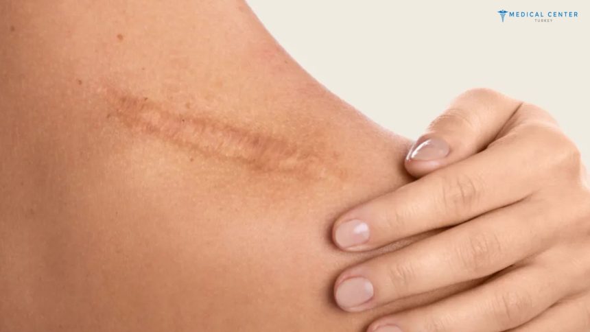 Scar Revision Surgery in Turkey and Functional Outcomes