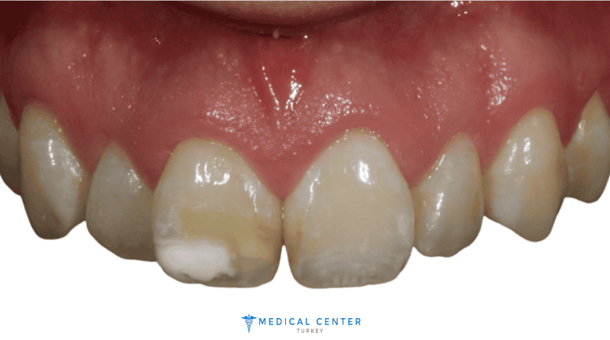 Effective Treatments for Tooth Discoloration in Turkey