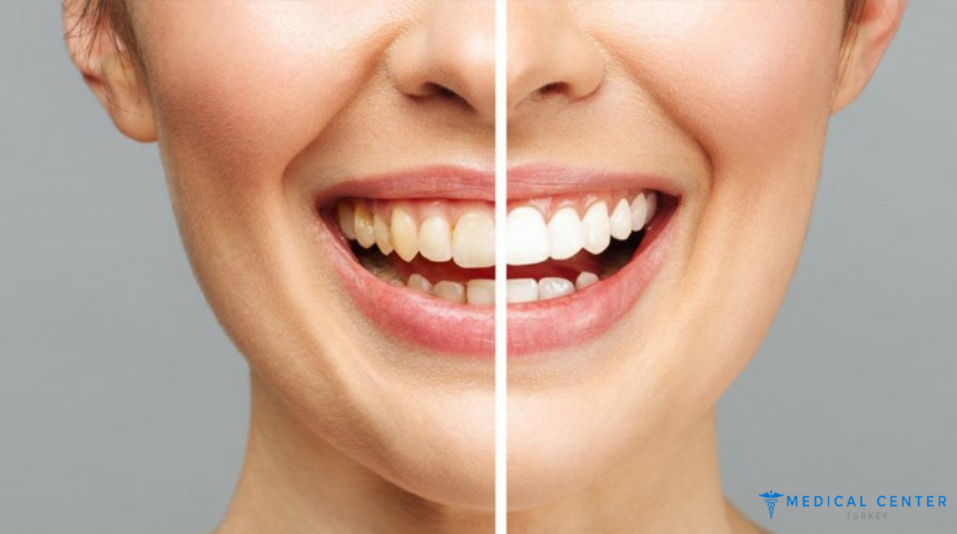 Effective Treatments for Tooth Discoloration in Turkey