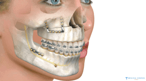 Jaw Correction Procedures in Turkey 4