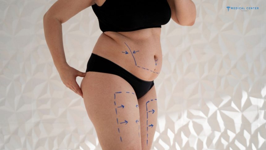 Liposuction in Turkey: Types, Prices, Procedures Liposuction in Turkey: Types, Prices, Procedures