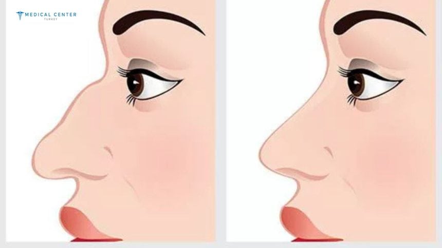 Rhinoplasty in Turkey: Types, Prices, Procedures Rhinoplasty in Turkey: Types, Prices, Procedures