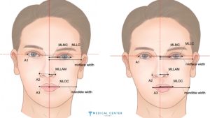 Achieving Symmetry Asymmetry Correction Procedures in Turkey 2