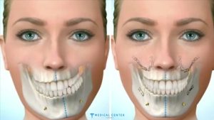 Achieving Symmetry Asymmetry Correction Procedures in Turkey 