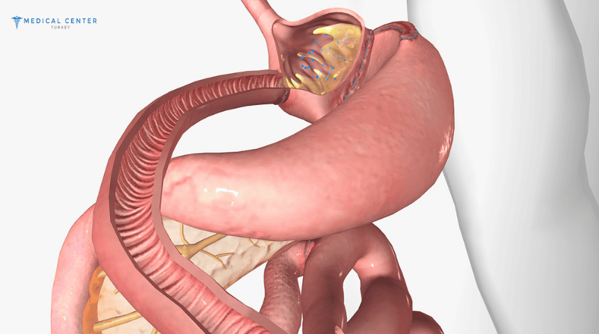 What is the Price of a Gastric Bypass in Turkey? What is the Price of a Gastric Bypass in Turkey ?