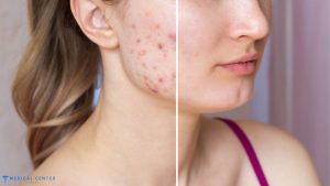 Customized Skin Care Treatments for Acne and Scarring in Turkey