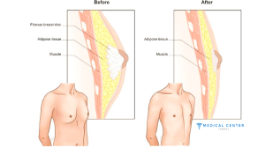 Gynecomastia in Turkey at a Glance 