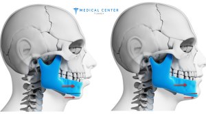 How Much Does Jaw Surgery Cost in Turkey?