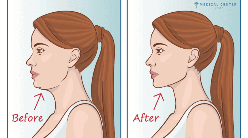 Understanding the Benefits of Jawline Contouring in Turkey