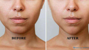 Are You Suitable for Jaw Surgery in Turkey?