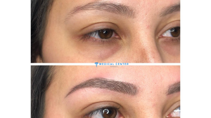 Microblading in Turkey: Types, Prices, Procedures
