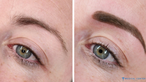 Microblading in Turkey: Types, Prices, Procedures