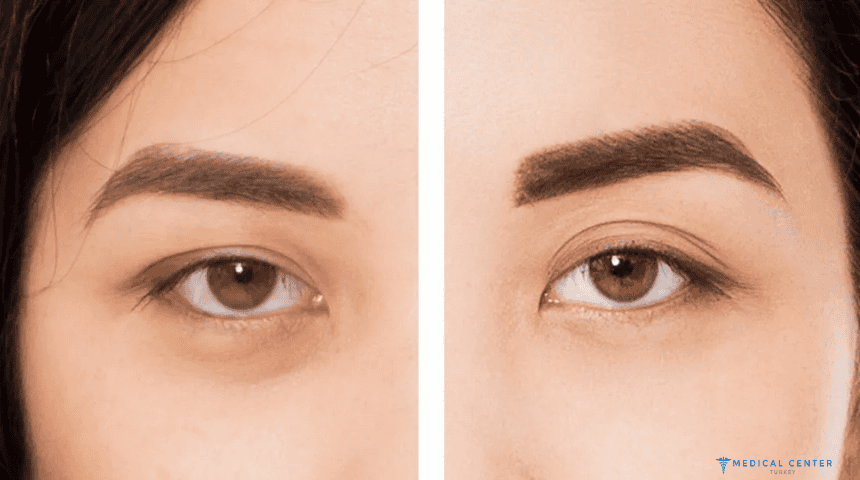 Non-Surgical Brow Lift Techniques in Turkey